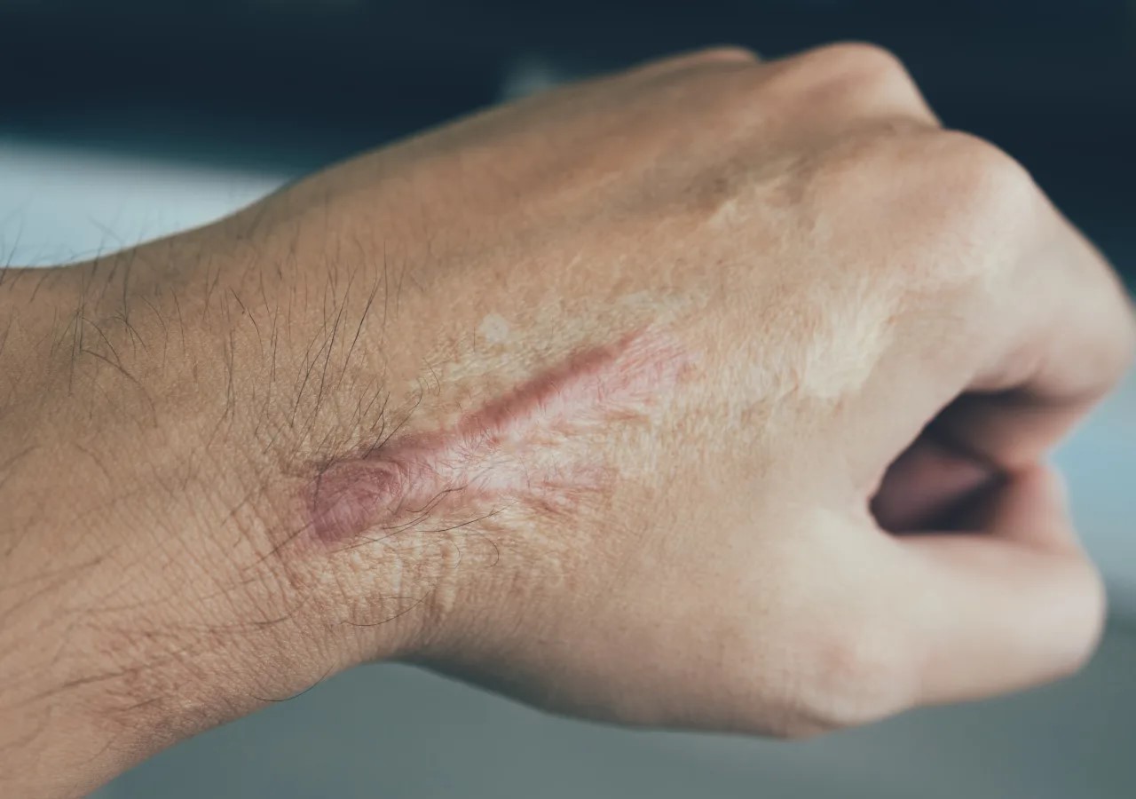 جای زخم قدیمی - از بین بردن جای زخم کهنه