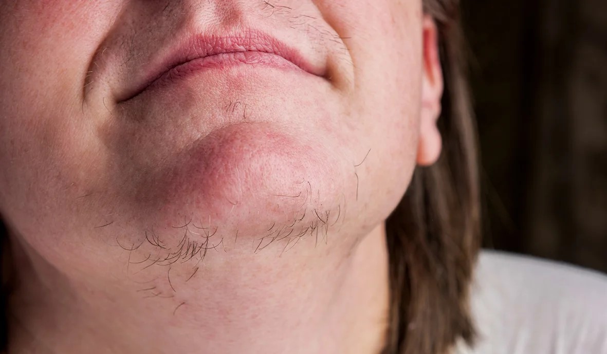 موهای زائد صورت - از بین بردن موهای زائد در یک روز