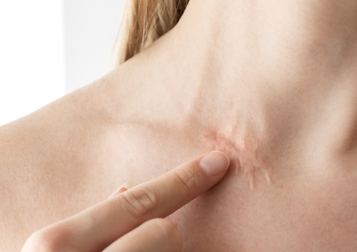 از بین بردن جای زخم کهنه