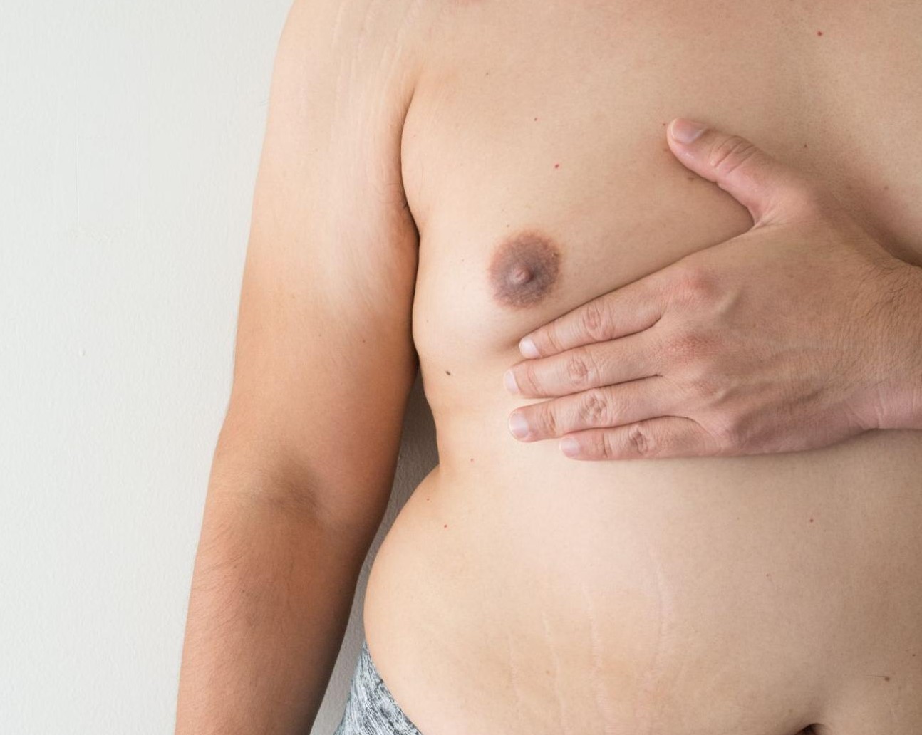 افتادگی سینه مردانه - کوچک کردن سینه مردان