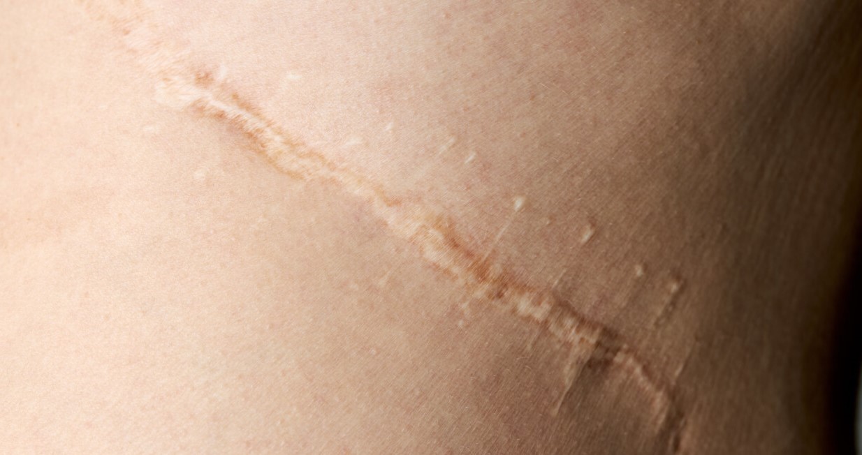 درمان جای بخیه - از بین بردن جای زخم کهنه