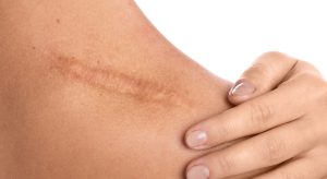 از بین بردن جای زخم کهنه