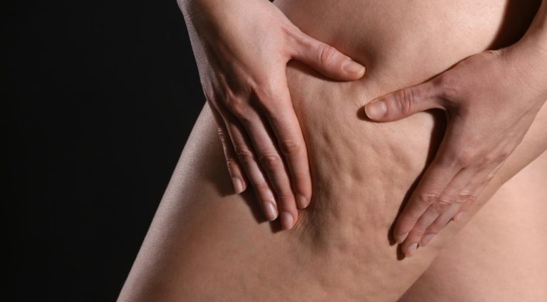 درمان سلولیت ران