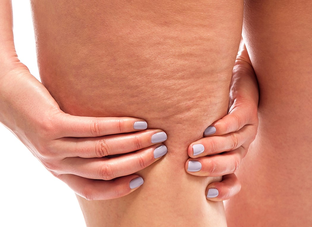 درمان سلولیت - درمان سلولیت ران