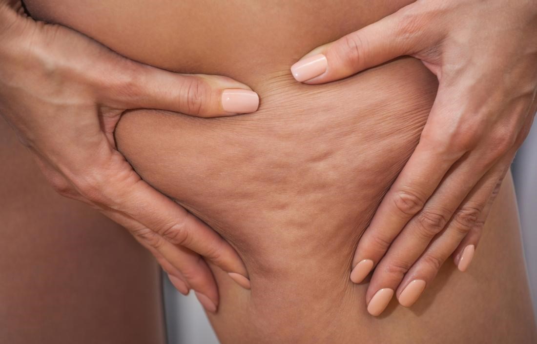 سلولیت - درمان سلولیت ران