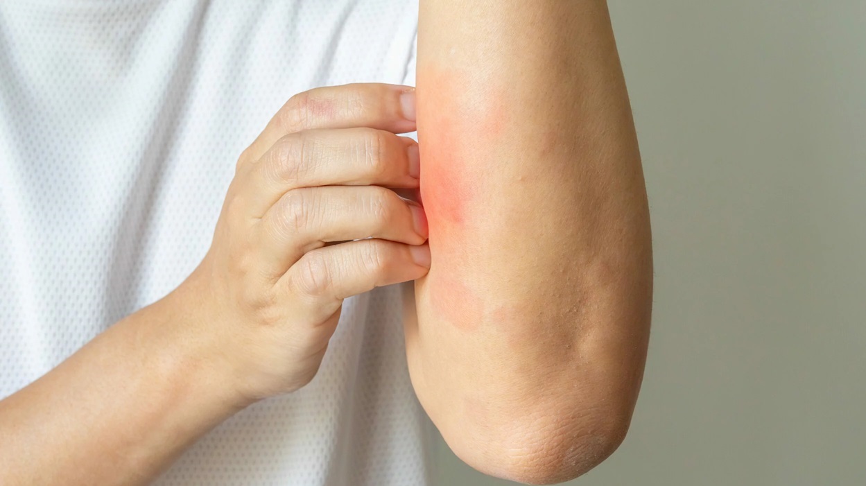 خارش پوست - کمبود ویتامین و خارش پوست