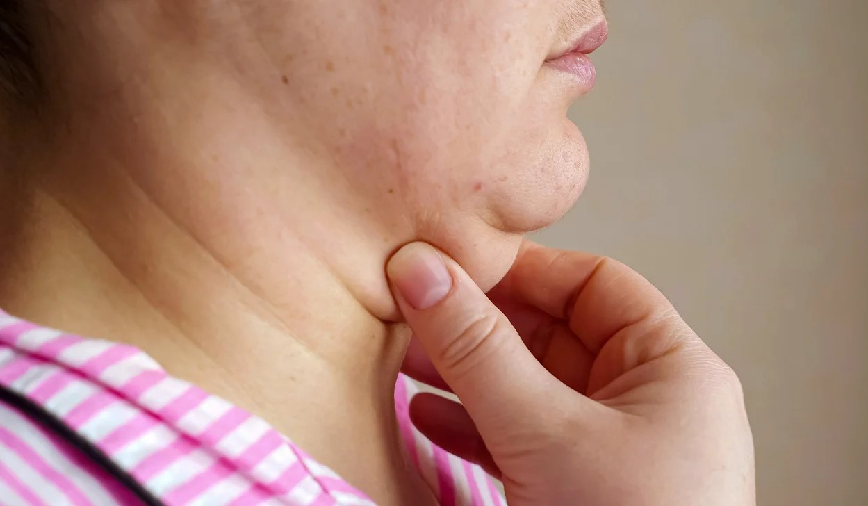 رفع غبغب - فواید آدامس جویدن برای غبغب