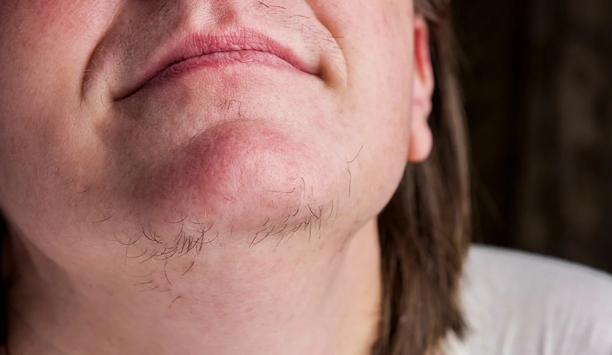 موهای زائد چانه - علت موهای زائد زیر چانه