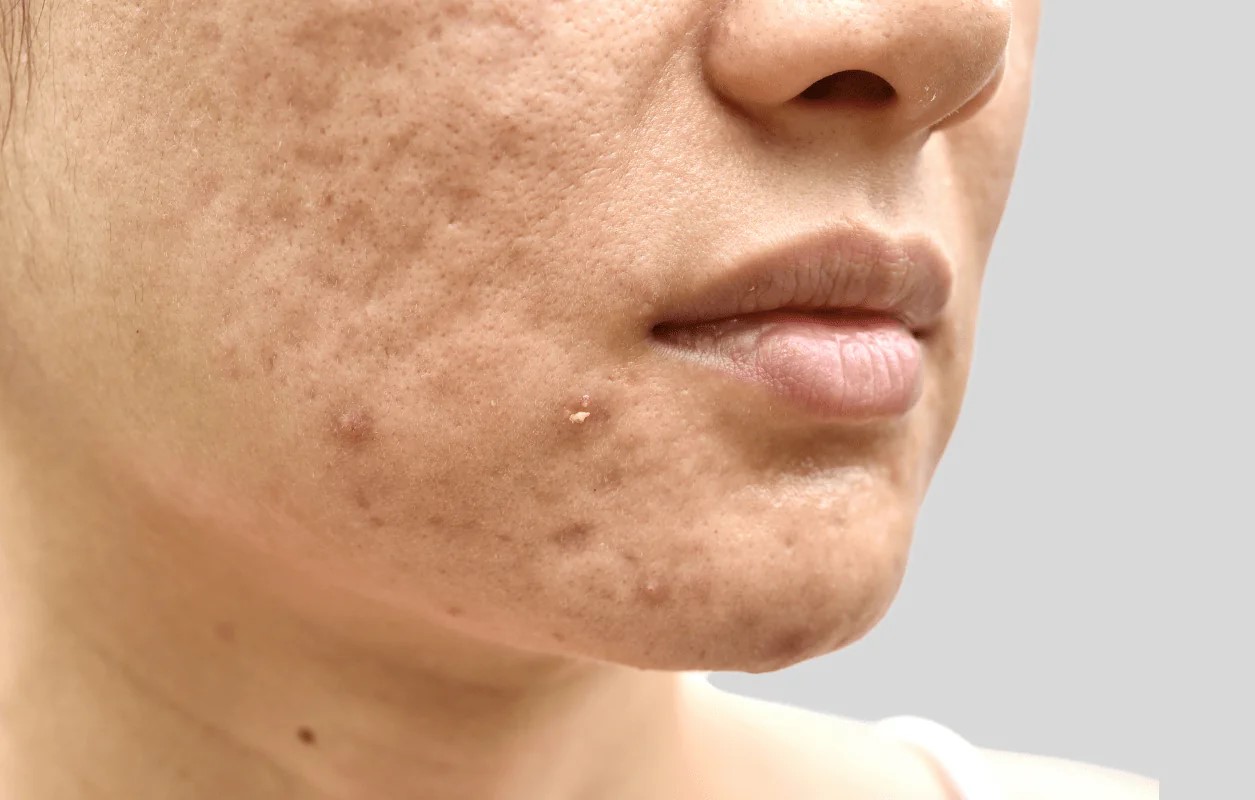 درمان جای جوش - از بین بردن جوش برای همیشه