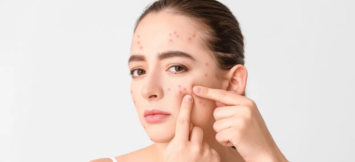 ماسک ضد جوش صورت - از بین بردن جوش برای همیشه