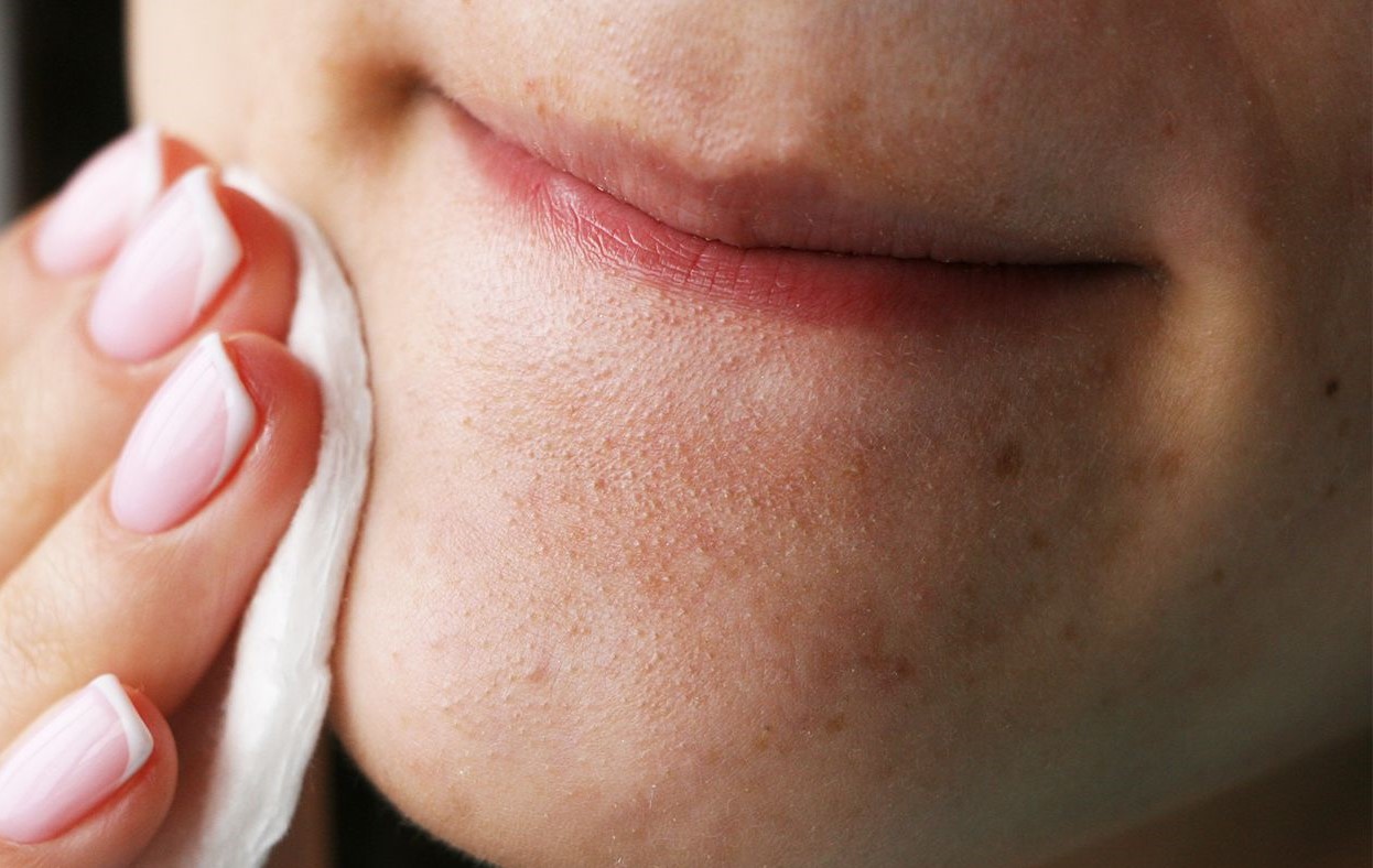 درمان جای جوش - از بین بردن جوش برای همیشه