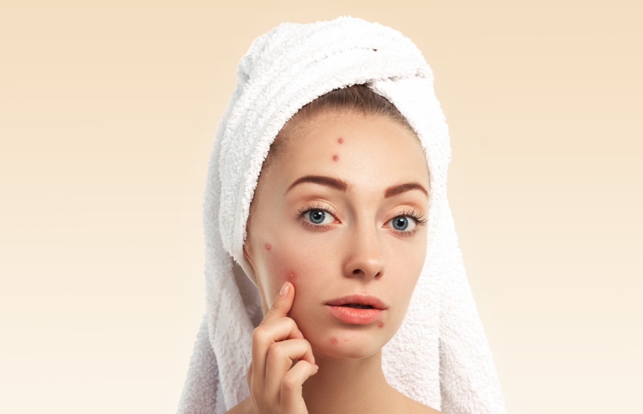 درمان جوش با آنتی بیوتیک - از بین بردن جوش برای همیشه