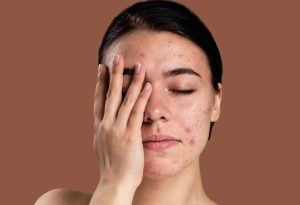 از بین بردن جوش برای همیشه