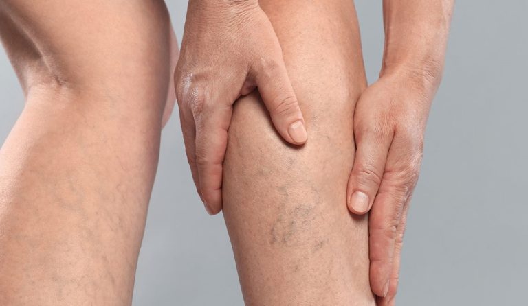 ورزش برای واریس پا