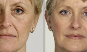 تصویر خانمی که هایفوتراپی صورت و خط خنده انجام داده