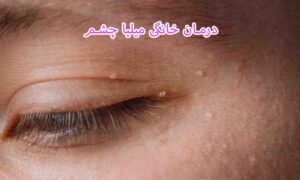 کک و مک صورت - درمان خانگی میلیا چشم