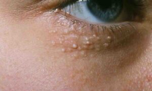 جوش سر سفید زیر چشم - جلوگیری از کپک زدن خیارشور