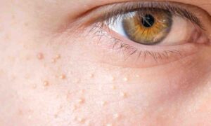 جوش های برجسته زیر چشم - درمان خانگی میلیا چشم