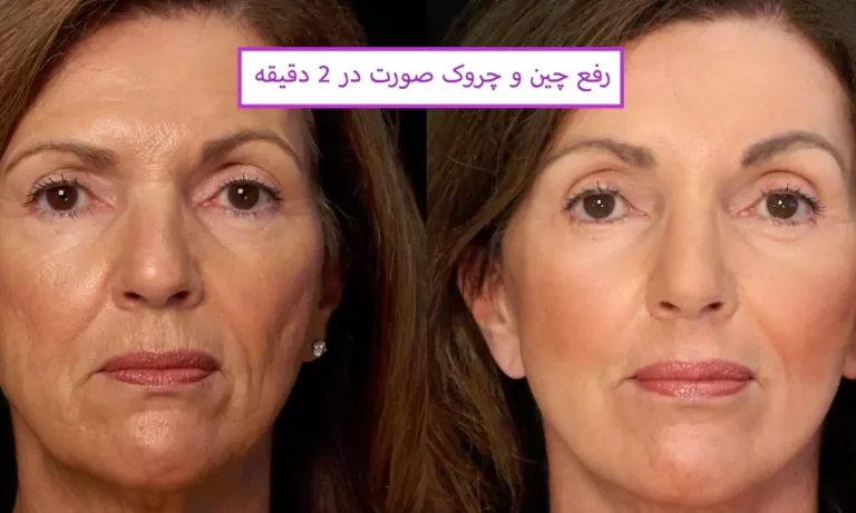 رفع چین و چروک صورت در ۲ دقیقه