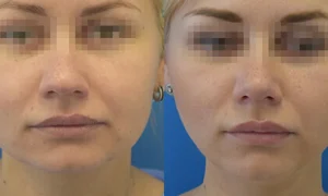 درمان ورم صورت بعد هایفوتراپی شامل چه مواردی می شود؟