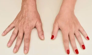 رفع سریع چروک دست با روش های درمانی