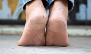 درمان ترک پا و درمان ترک پاشنه پا