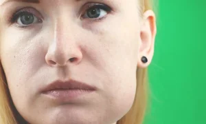 ورم صورت بعد از هایفو و درمان ورم صورت بعد هایفو