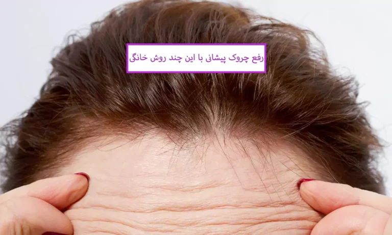 رفع چروک پیشانی با این چند روش خانگی