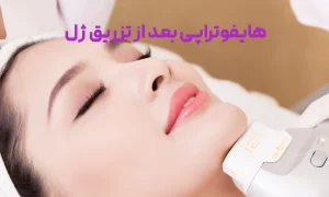 آیا بعد از تزریق ژل می توان هایفو کرد؟