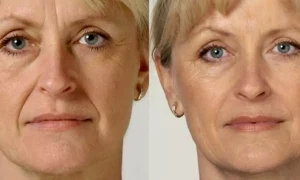 انواع روغن درمانی برای کاهش چروک های عمیق صورت