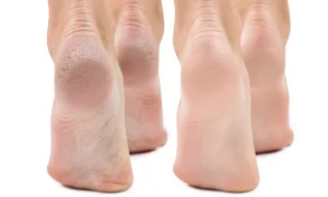 بهترین دارو برای درمان ترک پا و درمان ترک پاشنه پا