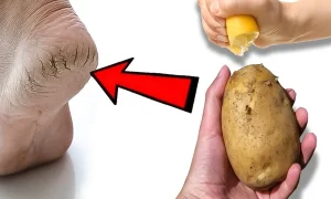 روش های خانگی درمان ترک پا و درمان ترک پاشنه پا