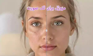 مزوژل برای لک صورت
