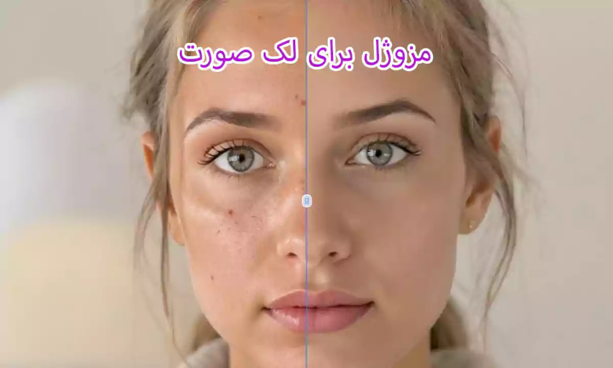 مزوژل برای لک صورت