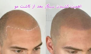 اهمیت کشیدن سیگار بعد از کاشت مو