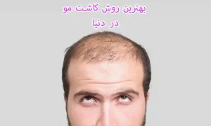 بهترین روش کاشت مو در دنیا
