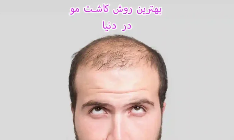 بهترین روش کاشت مو در دنیا