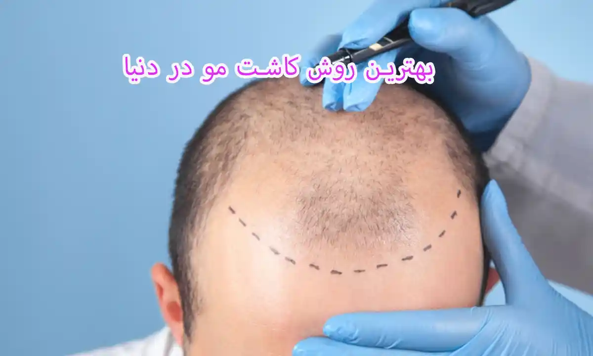 بهترین روش کاشت مو در دنیا