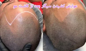 عوارض کشیدن سیگار بعد از کاشت مو