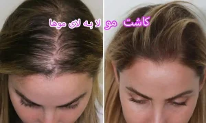 کاشت مو لا به لای موها