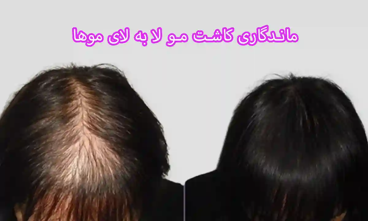 ماندگاری کاشت مو لا به لای موها چقدر است؟