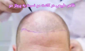 ظاهر طبیعی در کاشت مو نسبت به پروتز مو