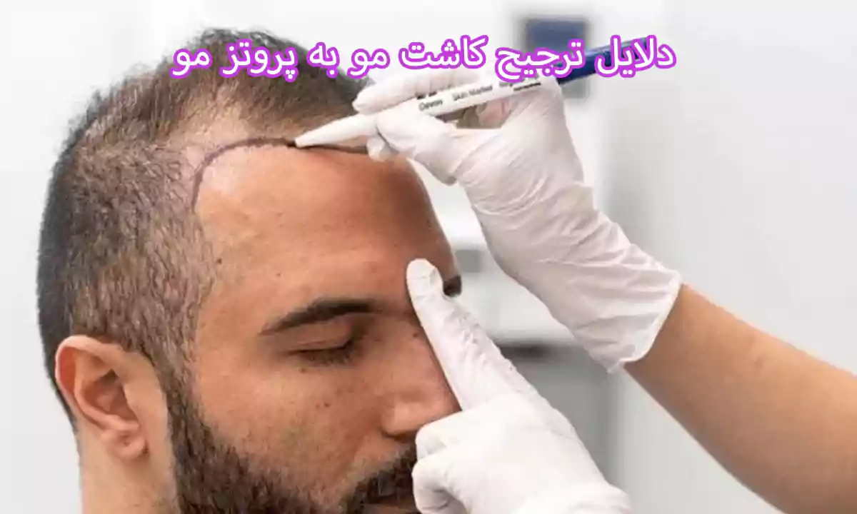 دلایل ترجیح کاشت مو به پروتز مو