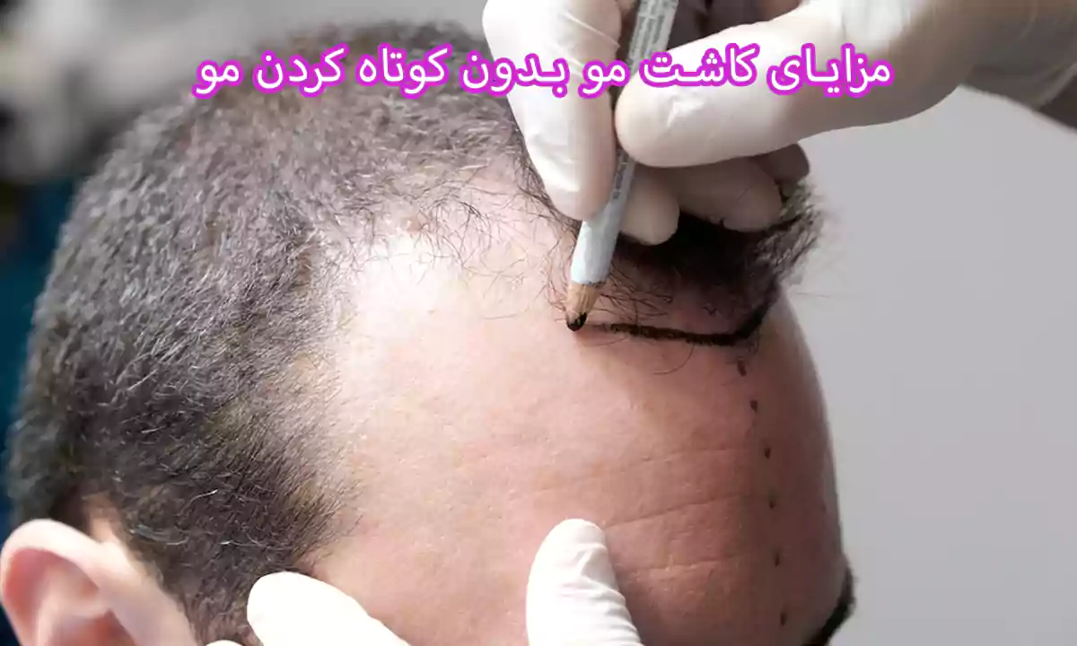 مزایای کاشت مو بدون کوتاه کردن مو