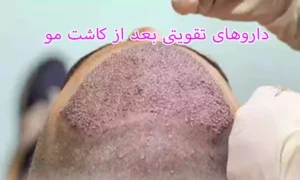 داروهای تقویتی بعد از کاشت مو
