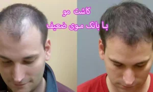 کاشت مو با بانک موی ضعیف