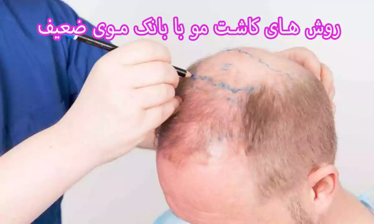 کاشت مو با بانک موی ضعیف با چه روش هایی انجام می شود؟