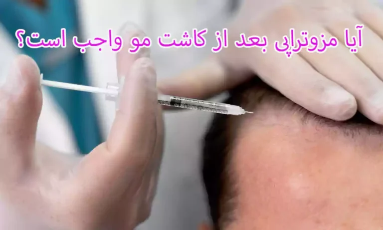 ⁠آیا مزوتراپی بعد از کاشت مو واجب است؟