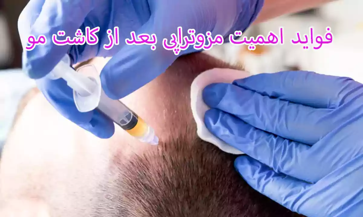 فواید اهمیت مزوتراپی بعد از کاشت مو