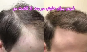 قرص برای خارش سر بعد از کاشت مو